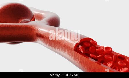 A 3d rendering of a cerebral aneurysm, illustrating the structural ...