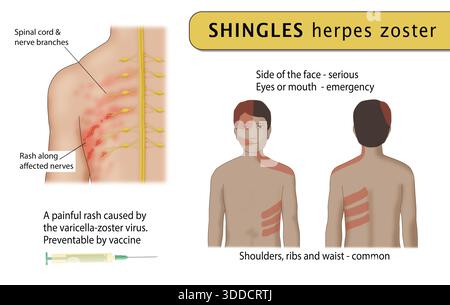 A medical illustration of the most common areas of the body for the ...