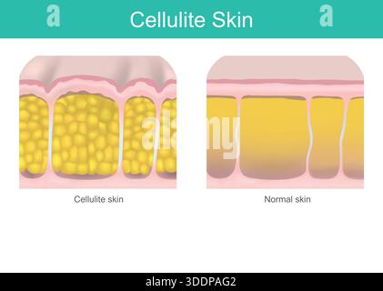 Adipose tissue fat cell, skin layer anatomy structure. Human body lipid ...
