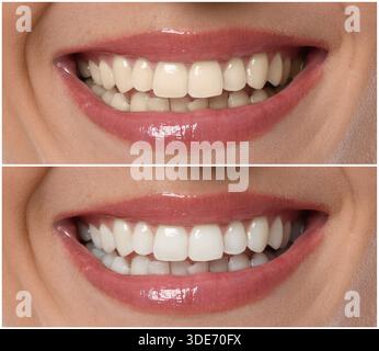 Smiling woman before and after teeth whitening treatment, closeup. Collage Stock Photo