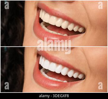 Smiling woman before and after teeth whitening treatment, closeup. Collage Stock Photo