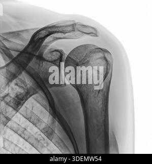 X-ray image of a body. Xray image of female shoulder isolated on white background. diagnosis Subacromial Syndrome Stock Photo