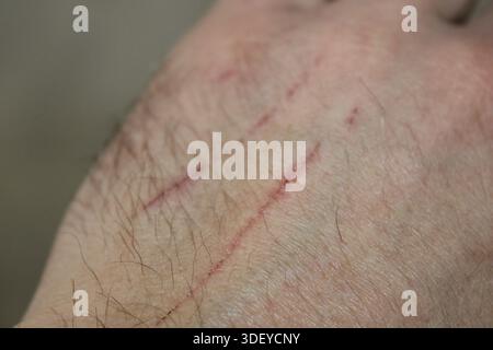 A hand with fresh cuts shows signs of healing after receiving medical attention. The cuts appear red and raised on the skin, indicating recent injury. Stock Photo