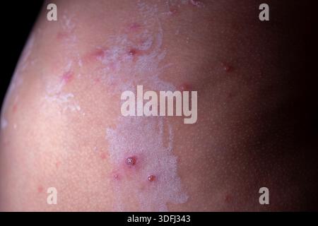 Close-up of skin with acne and scarring, showing texture and imperfections Stock Photo
