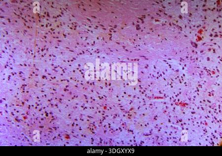 Photomicrograph of a human brain tissue biopsy specimen from a case of ...