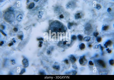 A photomicrograph shows a section of brain tissue with a meningeal ...