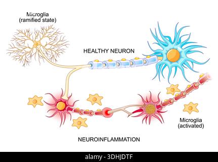 Neuroinflammation. Healthy neuron and unhealthy nerve cell. Inflammaging. Ageing process. Microglia ramified state and glial cell after activation. Ve Stock Vector