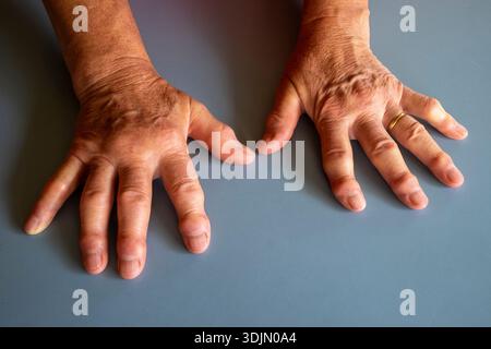The arthritis affected knuckles of a 70 year old woman Stock Photo