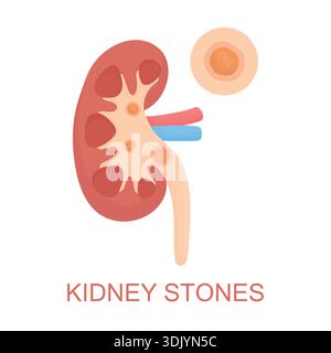 Vector illustration of a human kidney with stones isolated on white background. Clear visual concept of kidney problems, pain, discomfort Stock Vector