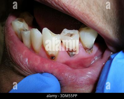 Tooth decay (dental caries) at the root of a patient's teeth. Caries is the decay and crumbling of teeth caused by bacteria in plaque, a substance that covers the surface of unclean teeth. Stock Photo