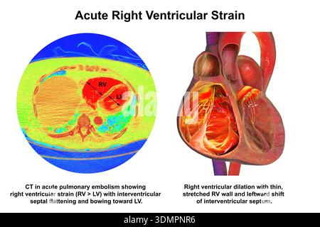 Illustration of right ventricular dilation showing a CT scan (left) and ...
