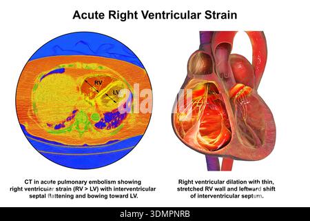 Illustration of right ventricular dilation showing a CT scan (left) and ...