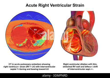 Illustration of right ventricular dilation showing a CT scan (left) and ...