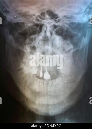 Frontal view of a human head X-ray showing skull structure, jaw, and teeth. Medical diagnostic imaging for healthcare, stomatology, vertical Stock Photo
