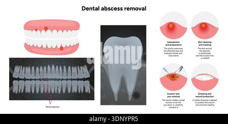 Hand-drawn dental illustration showing the process of dental abscess ...