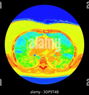 Coloured computed tomography (CT) scan of an axial section of human ...