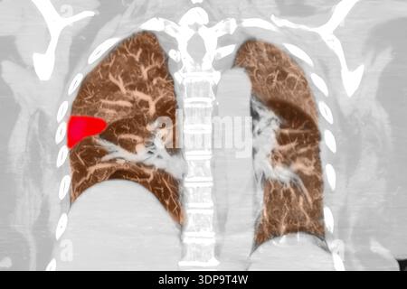 Wedge Infarction CT scan showing wedge-shaped pulmonary infarction in right lung (left ...