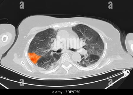 Wedge Infarction CT scan showing wedge-shaped pulmonary infarction in right lung (left ...
