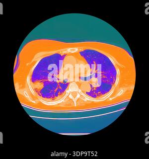 Wedge Infarction CT scan showing wedge-shaped pulmonary infarction in right lung (left ...