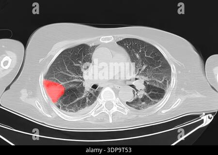 CT scan showing wedge-shaped pulmonary infarction in the right lung ...