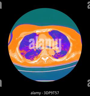 CT scan showing wedge-shaped pulmonary infarction in the right lung ...