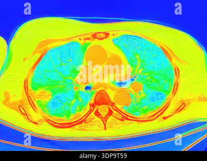 Wedge Infarction CT scan showing wedge-shaped pulmonary infarction in the right lung ...