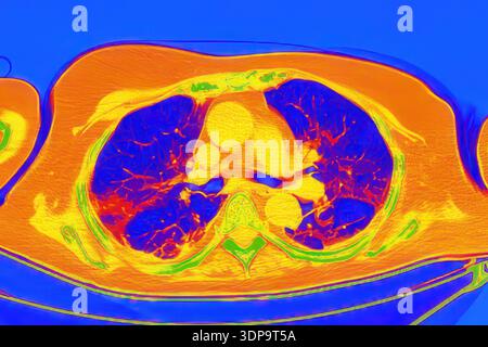 Lng Infarction CT scan showing wedge-shaped pulmonary infarction in the right lung ...