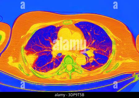 Wedge Infarction CT scan showing wedge-shaped pulmonary infarction in right lung (left ...