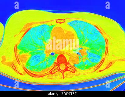 Wedge Infarction CT scan showing wedge-shaped pulmonary infarction in the right lung ...