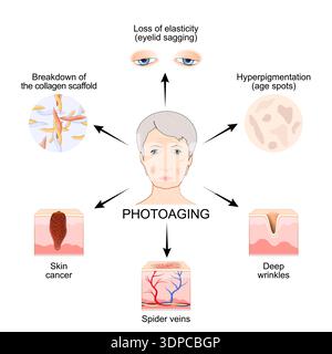 Photoaging. Symptoms of the skin aging process. Facial skin sags due to loss of collagen and elastin, hyperpigmentation from exposure to UV rays. Vect Stock Vector