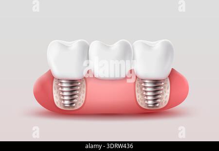 Dental bridge supported by two implants. A realistic 3D illustration of gum, bone, and healthy teeth. Vector illustration. Stock Vector