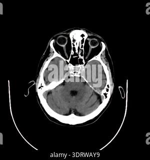 Human head CT scan presenting cranial anatomy including brain tissue, eye orbits, and skull structures, visualizing internal health for medical assess Stock Photo