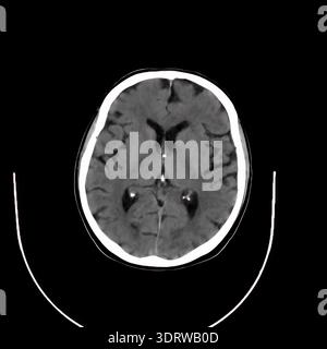 Human head CT scan presenting cranial anatomy including brain tissue, eye orbits, and skull structures, visualizing internal health for medical assess Stock Photo