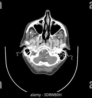 Human head CT scan on a black background displaying internal anatomy including brain, eyes, and skull structure, providing detailed medical imaging fo Stock Photo