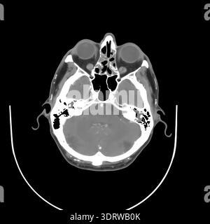 Human head CT scan on a black background displaying internal anatomy including brain, eyes, and skull structure, providing detailed medical imaging fo Stock Photo