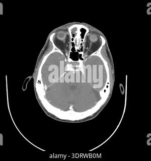 Human head CT scan on a black background displaying internal anatomy including brain, eyes, and skull structure, providing detailed medical imaging fo Stock Photo