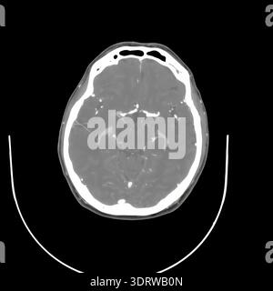 Human head CT scan on a black background displaying internal anatomy including brain, eyes, and skull structure, providing detailed medical imaging fo Stock Photo