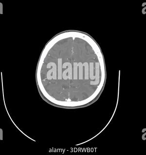 Human head CT scan on a black background displaying internal anatomy including brain, eyes, and skull structure, providing detailed medical imaging fo Stock Photo