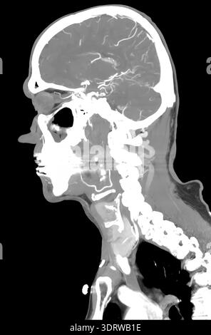 Human head CT scan showing brain and vascular system of a 72 year old ...