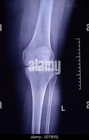 Arthrosis of the knee joint. X-ray image Stock Photo - Alamy