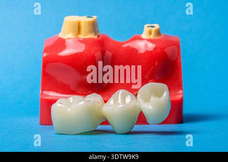 Dental bridge and model representing oral prosthesis concept Stock Photo