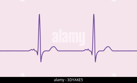 Illustration of electrocardiogram (ECG) with a P-mitrale pattern. It ...