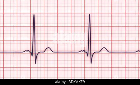Illustration of electrocardiogram (ECG) with a P-mitrale pattern. It ...