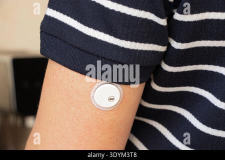 A continuous glucose monitoring sensor is attached to the skin of a man with diabetes, diabetes sugar control, medical devices, glucose measurement Stock Photo