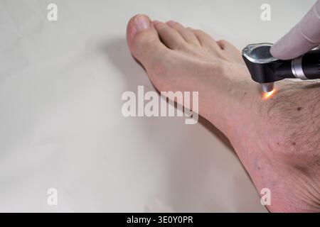 Dermatologist using dermatoscope on male foot and ankle for skin cancer screening, close-up dermoscopy exam detecting melanoma early with gloved hand Stock Photo