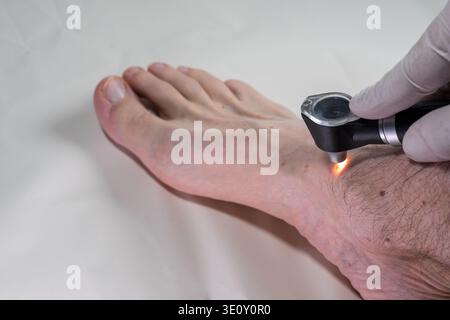 Dermatologist using dermatoscope on male foot and ankle for skin cancer screening, close-up dermoscopy exam detecting melanoma early with gloved hand Stock Photo
