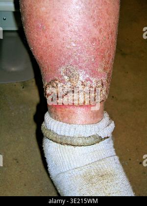 Swollen leg of a male patient with oedema. Oedema is swelling caused by fluid accumulating in body tissues. It is most common in the legs and ankle. It can be caused by several factors, including heart failure, kidney failure, cirrhosis of the liver and deficiencies in diet. Treatment is of the underlying cause, but the condition can be relieved with diuretic drugs. Stock Photo