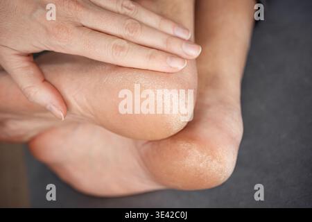 Close up of dry skin of feet, sole with scales and cracks. Legs, feet with dry skin on heels. Health care, body care and podology concept. Stock Photo