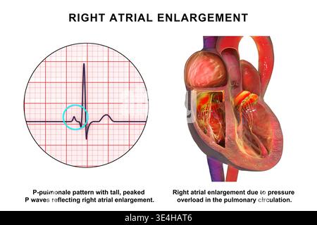 Right atrial dilation with P-pulmonale. Illustration showing an ...