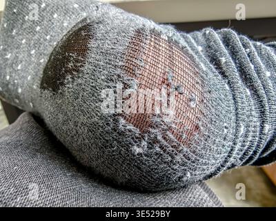 Worn-out sock on mans foot, close-up of damaged fabric and holes, everyday life detail showing clothing wear and tear and hygiene concept. Poor man Stock Photo